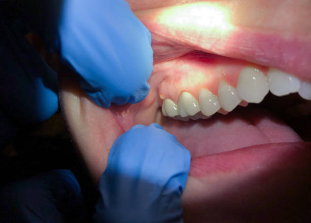 Best Knocked-Out Tooth (Avulsed Tooth) Treatment in Oradell, NJ